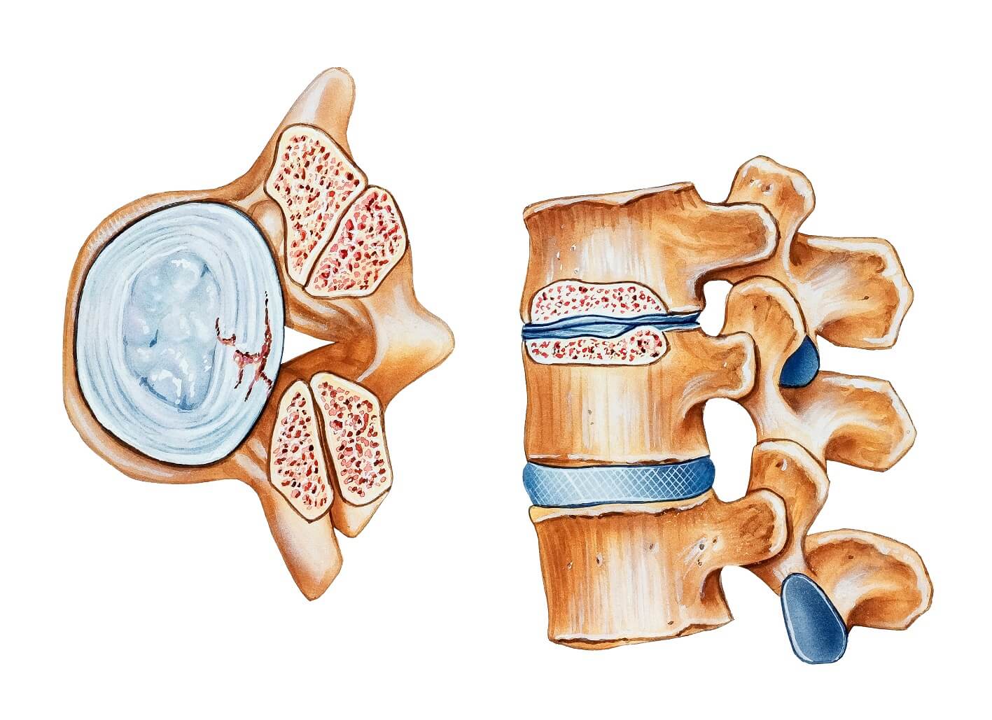 Spinalna stenoza 3